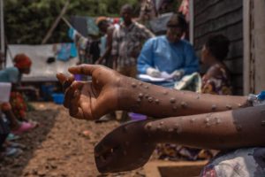 Ghana : un premier cas de MPOX enregistré